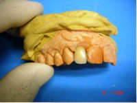 /album/galeria-de-fotos-carga-imediata-apos-exodontia-atraumatica-/carga-imediata-com-exodontia-atraumatica18-jpg/